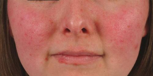 Lupus erythematosus, a disease that mimics others