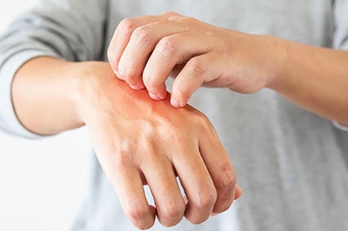 The Role of Nutrition in Atopic Dermatitis
