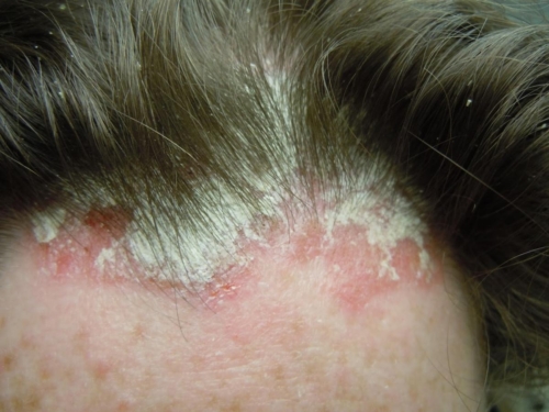 The permanent treatment of psoriasis with a different medical approach